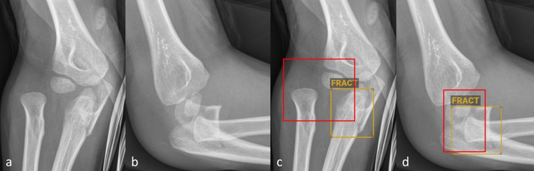 Abbildung 2: Anteroposteriore (a und c) sowie seitliche (b und d) Röntgenbilder des Ellbogens eines sechsjährigen Kindes ohne (a–b) und mit (c–d) Befundmarkierung durch BoneView. 